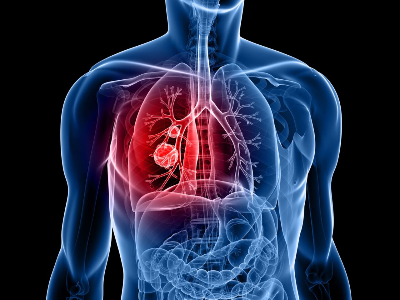 Lung-Cancer-GettyImages-94463987-1280x960.jpg